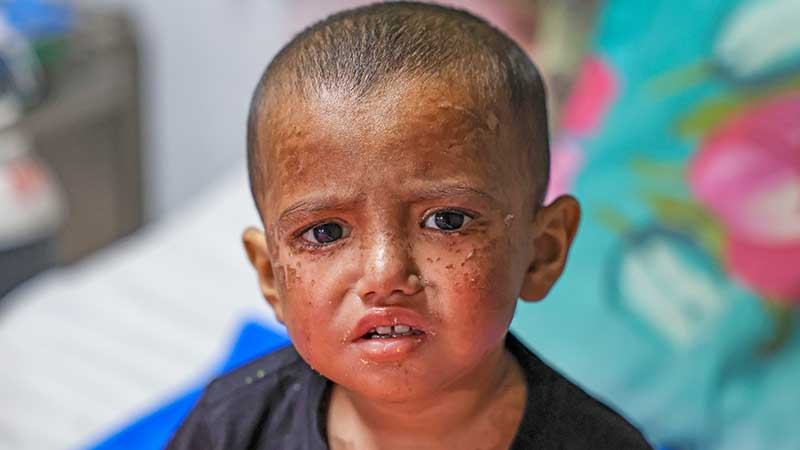 হাম রোধে করণীয়