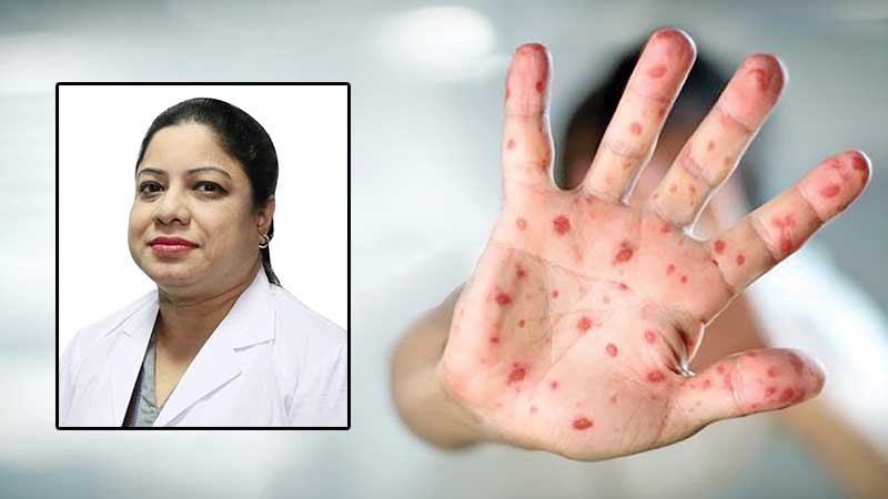চিকেন পক্স কেন হয়? আক্রান্ত হলে কী করবেন?
