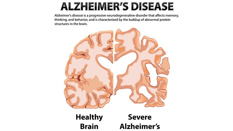 Alzheimer's-pacients