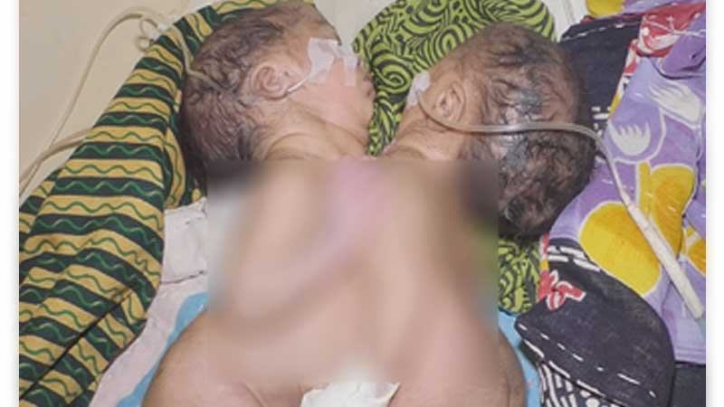 পেট জোড়া লাগানো শিশুদের পাঠানো হলো ঢাকায়