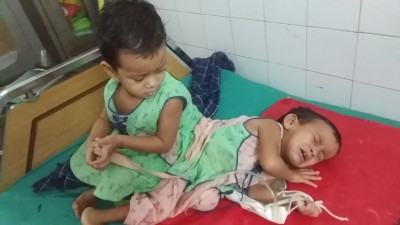 আলাদা হচ্ছে জোড়াশিশু লাবিবা-লামিসা