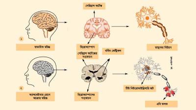ভুলে যাওয়া রোগের প্রাদুর্ভাব বেশি নারীদের মধ্যে