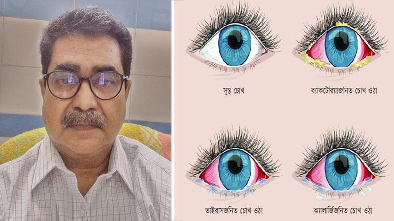 কনজাংটিভাইটিস : ছোঁয়াচে, তবে বাতাসে ছড়ায় না