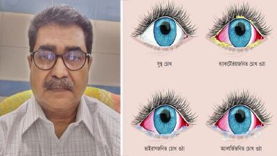 কনজাংটিভাইটিস : ছোঁয়াচে, তবে বাতাসে ছড়ায় না